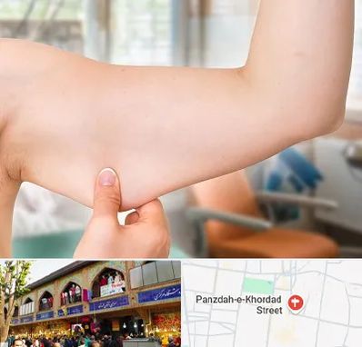 براکیوپلاستی در 15 خرداد