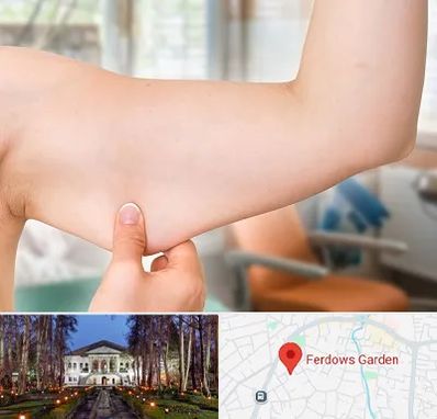 براکیوپلاستی در باغ فردوس