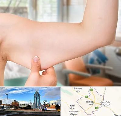 براکیوپلاستی در تایباد