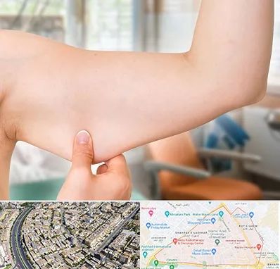 براکیوپلاستی در شهرک غرب مشهد