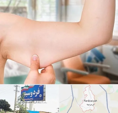 براکیوپلاستی در فردوسیه شهریار