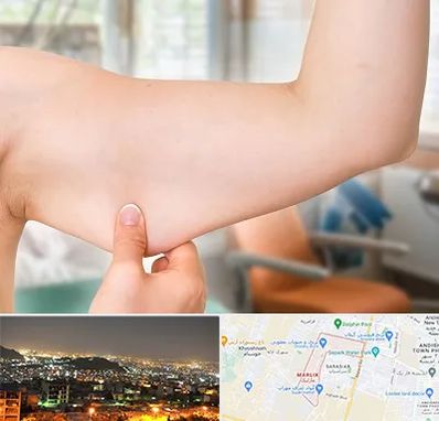 براکیوپلاستی در مارلیک کرج