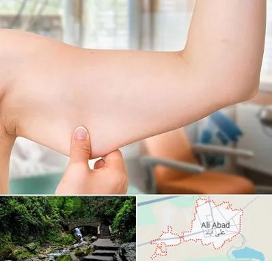 براکیوپلاستی در علی آباد کتول