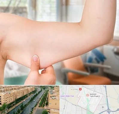 براکیوپلاستی در فاز سه اندیشه