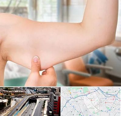 براکیوپلاستی در ستارخان شیراز