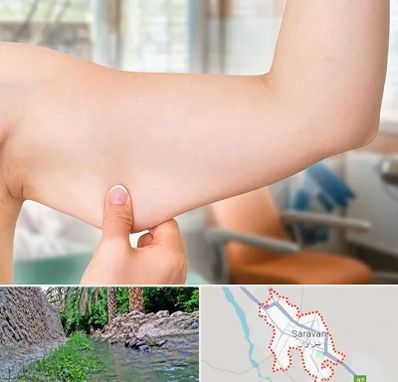 براکیوپلاستی در سراوان