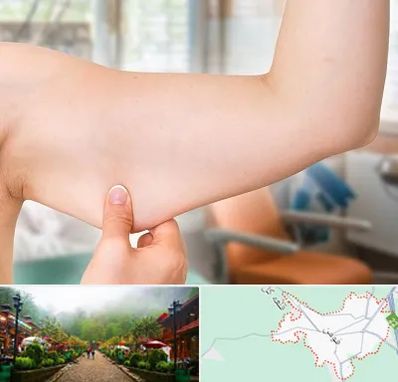 براکیوپلاستی در فومن