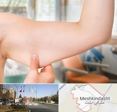 براکیوپلاستی در مشکین دشت