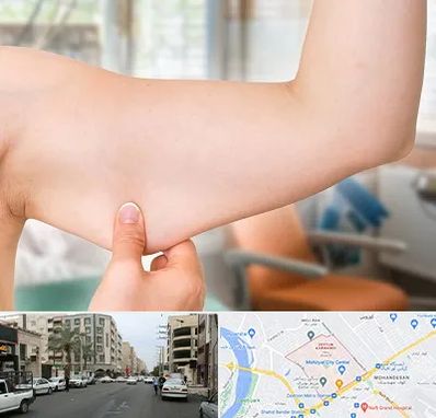 براکیوپلاستی در زیتون کارمندی اهواز