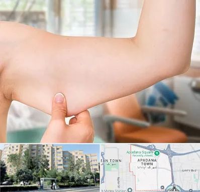 براکیوپلاستی در آپادانا