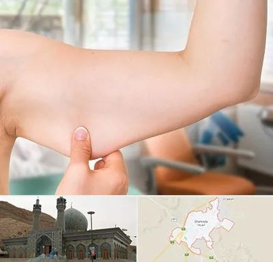 براکیوپلاستی در شهرضا