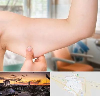 براکیوپلاستی در قوچان