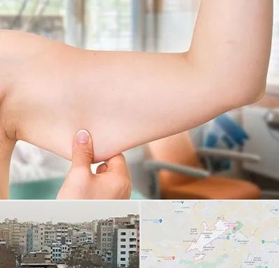 براکیوپلاستی در محمد شهر کرج