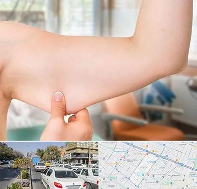 براکیوپلاستی در مفتح مشهد