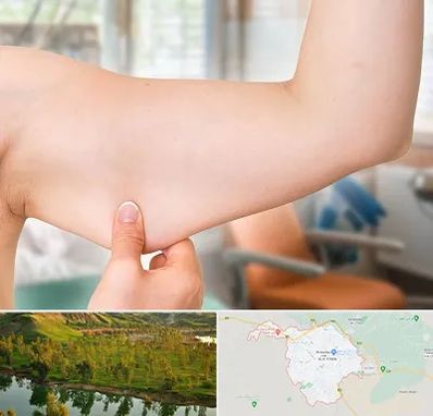 براکیوپلاستی در بهبهان