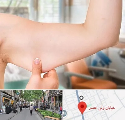 براکیوپلاستی در ولیعصر شهریار