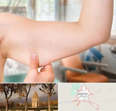 براکیوپلاستی در تویسرکان