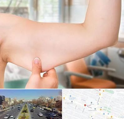 براکیوپلاستی در بلوار معلم مشهد