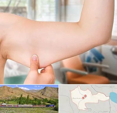 براکیوپلاستی در خاش