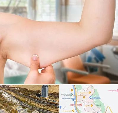 براکیوپلاستی در خیابان نیایش شیراز