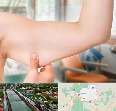 براکیوپلاستی در مراغه