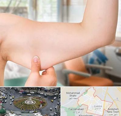 براکیوپلاستی در فردیس کرج 