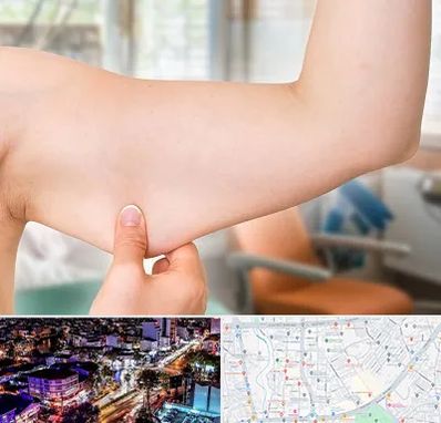 براکیوپلاستی در منظریه رشت