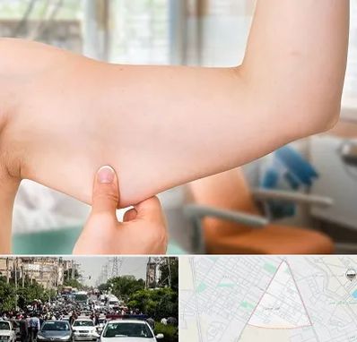 براکیوپلاستی در سیدی مشهد