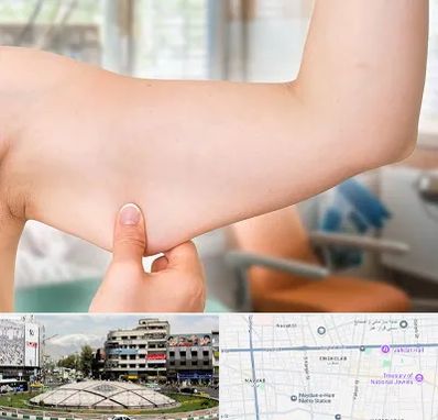 براکیوپلاستی در مرکز تهران