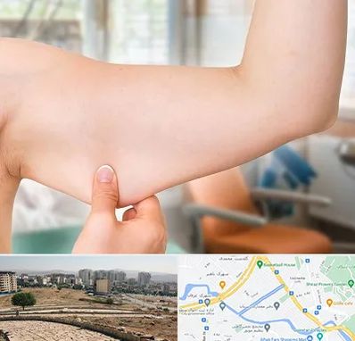 براکیوپلاستی در کوی وحدت شیراز