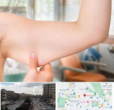 براکیوپلاستی در بلوار فردوسی مشهد