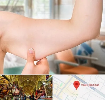 براکیوپلاستی در بازار وکیل شیراز