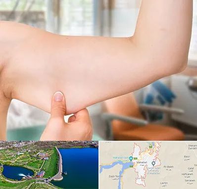 براکیوپلاستی در مهاباد