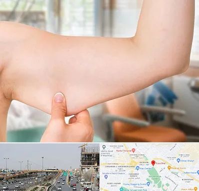 براکیوپلاستی در بلوار توس مشهد