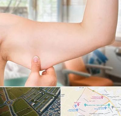 براکیوپلاستی در الهیه مشهد