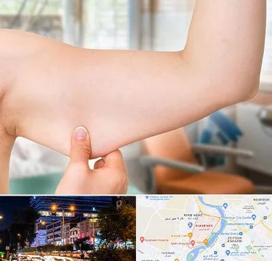 براکیوپلاستی در کیانپارس اهواز