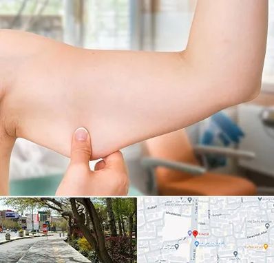 براکیوپلاستی در خیابان توحید اصفهان