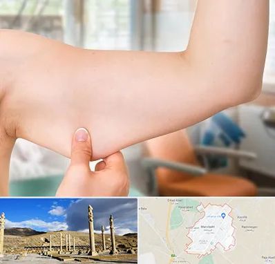 براکیوپلاستی در مرودشت