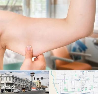 براکیوپلاستی در 17شهریور