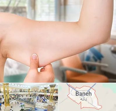 براکیوپلاستی در بانه
