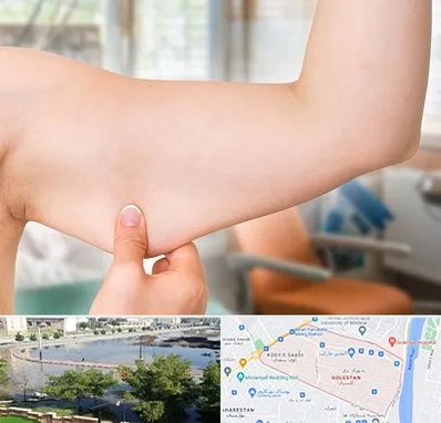 براکیوپلاستی در گلستان اهواز