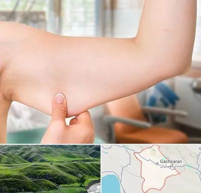 براکیوپلاستی در گچساران