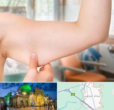 براکیوپلاستی در آستانه اشرفیه