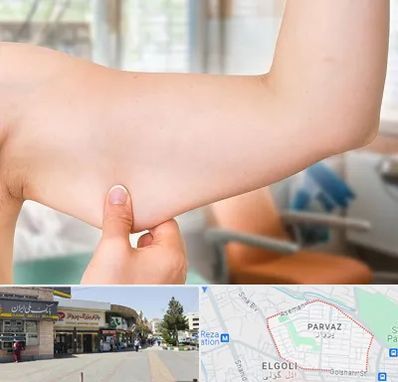 براکیوپلاستی در پرواز تبریز