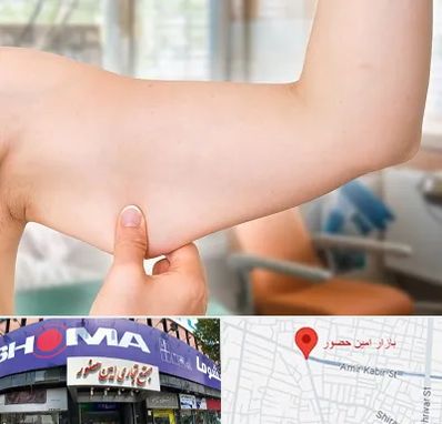 براکیوپلاستی در امین حضور