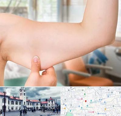 براکیوپلاستی در میدان شهرداری رشت