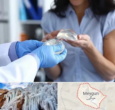 پروتز باسن در میگون