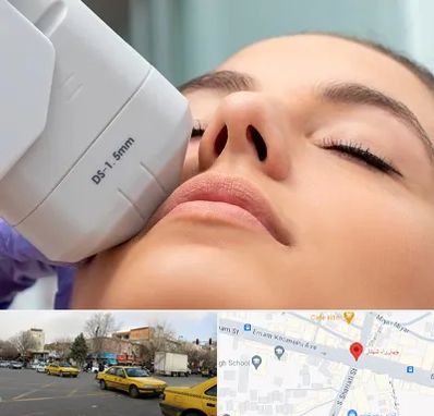 هایفوتراپی در شهناز تبریز