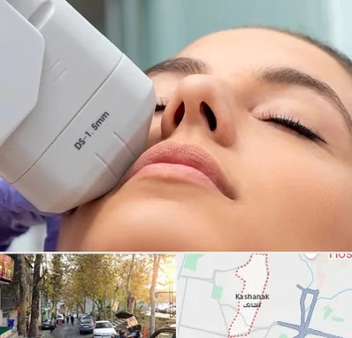 هایفوتراپی در کاشانک