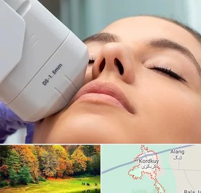 هایفوتراپی در کردکوی